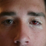 pinkeye